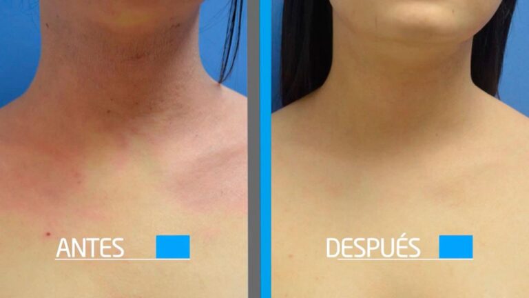 Dermatitis Atópica entre las enfermedades de la piel más frecuentes en México