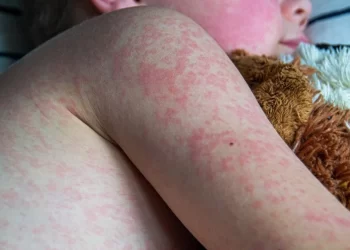 primera muerte por sarampión en Durango